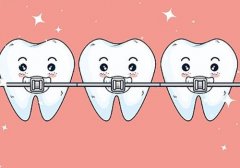 牙齿整形有几种方法？整牙的方法包括活动矫正、隐形矫正、固定矫正